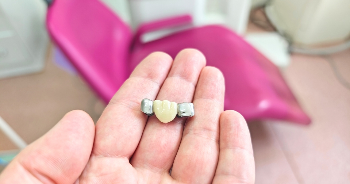 Why Celebrities and Dentists Prefer Porcelain Crowns